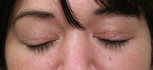 SWMD (EYELASH) AFTER