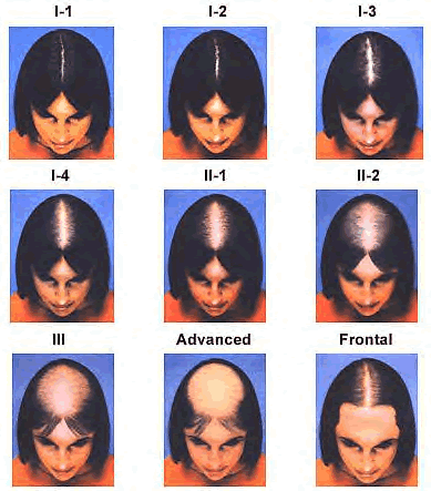 Bald Pattern