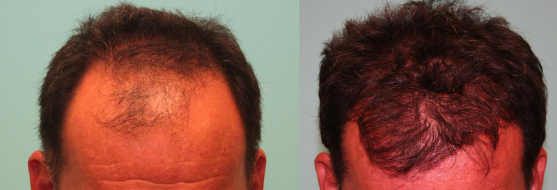This patient received 22-2500 grafts using the FUE method.  Photos were taken the day of surgery and 1 year after.  Patient was 55 years old and this was his first hair transplant.