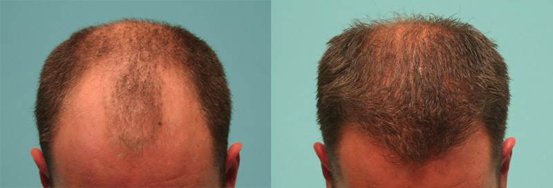 Patient (KM) received 2300 grafts to his hairline, frontal area, and fronto-temporal corners using the FUE (Follicular Unit Extraction) method.  After photo was taken at 6 month follow up.