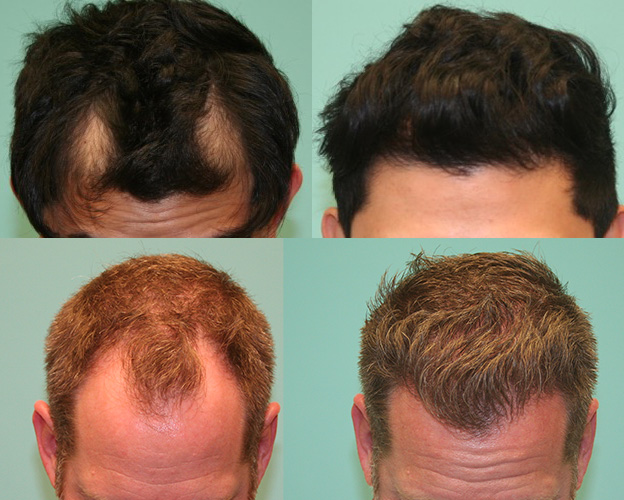 Natural Hairline Restoration