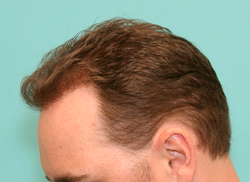 Concered About Thinning and Irritation On Hair Transplant Donor Scar -  Articles - Sara Wasserbauer MD