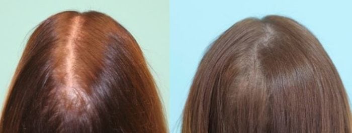 SMP for female diffuse hair loss of the crown