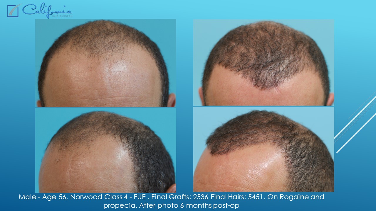 FUE - Wear Your Hair Short After Hair Transplant - Case Study - Sara  Wasserbauer MD