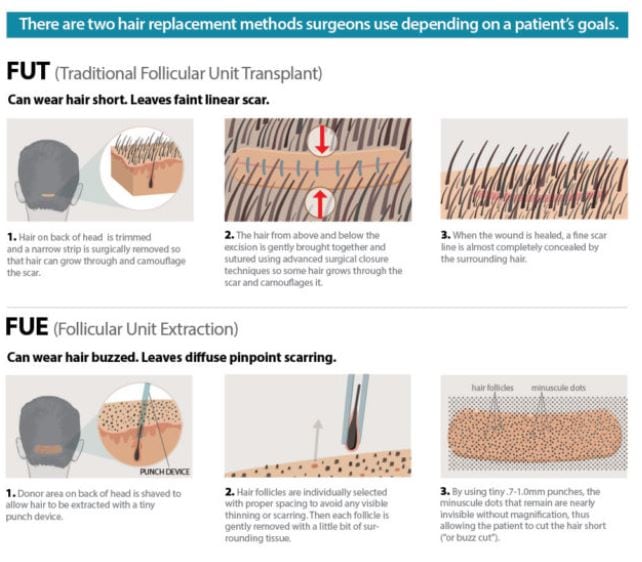 What is Follicular Unit Extraction (FUE)? - News - Sara Wasserbauer MD