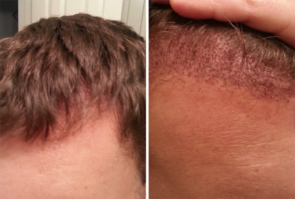 My hair line 1 day after hair transplant surgery.