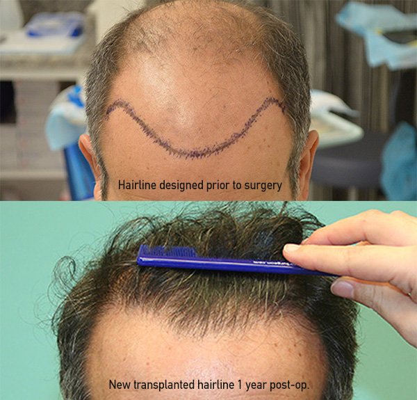 Medical Hair Restoration, Hair Replacement, Hair Transplant, Hair  Transplantation, California, (CA)