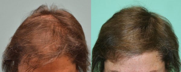 SMP for Female diffuse hair loss