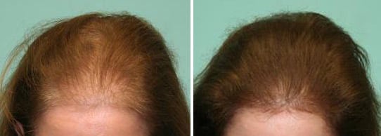 SMP for Female frontal hair loss