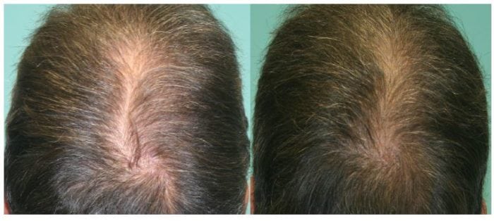 SMP thickening of a hair transplant central region.