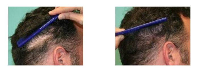 SMP to camouflage previous hair transplant strip scar