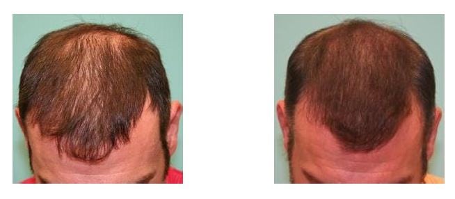 SMP thickening of male with diffuse hair loss