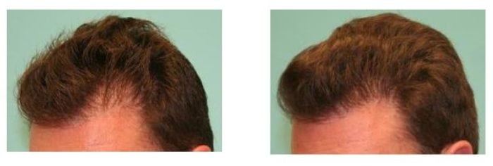 SMP thickening of transplanted hair line