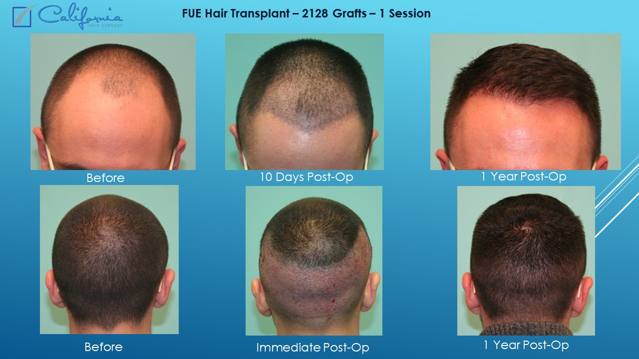 Follicular Unit Extraction | FUE Hair Transplant in Walnut Creek, San ...