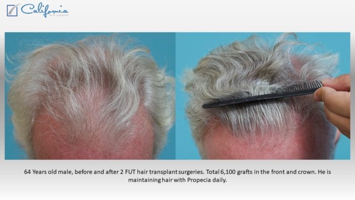 Hair Transplant Photos, Dr. Wasserbauer, San Francisco, , Northern  California