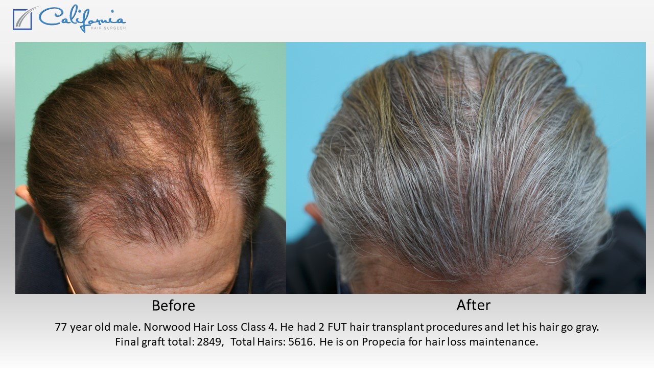 What happens when my hair goes gray after hair transplantation? - Case  Study - Sara Wasserbauer MD