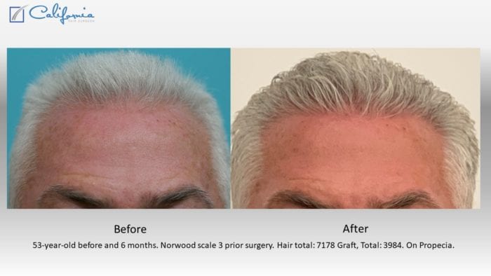 Hair Transplant Photos, Dr. Wasserbauer, San Francisco, , Northern  California