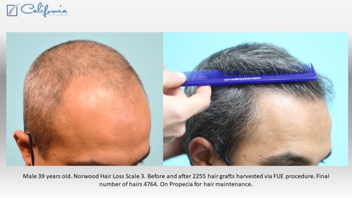 One Session 2250 FUE Graft Hair Transplant - Case Study - Sara Wasserbauer  MD