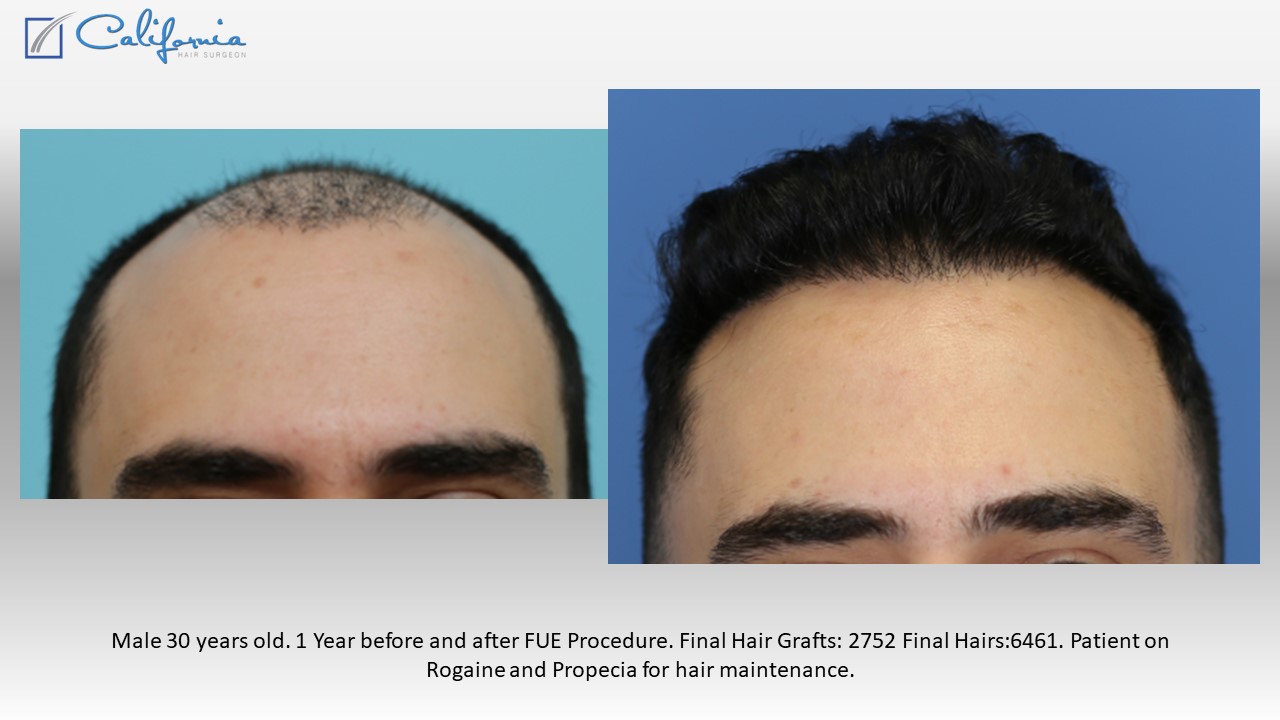 Hair Growth Time Lapse Case Study - Case Study - Sara Wasserbauer MD