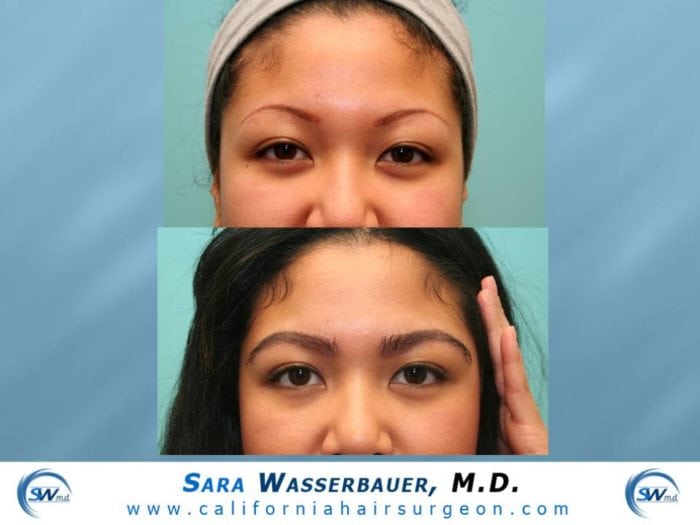 Eyebrow Hair Transplantation |Hair Restoration Surgeon | N. California