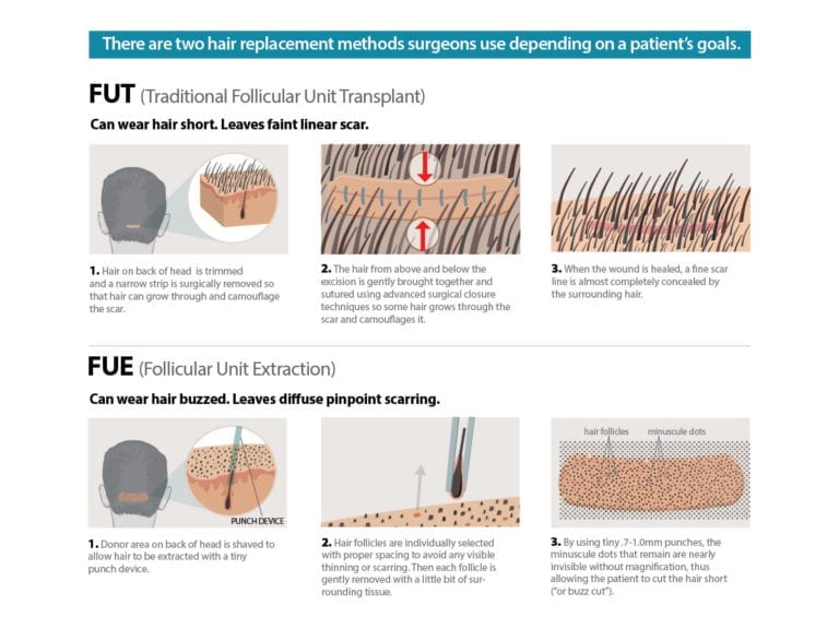 Follicular Unit Extraction | FUE Hair Transplant in Walnut Creek, San ...